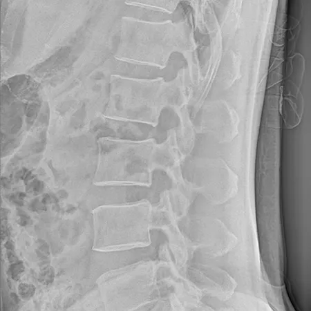 Radiographie de la colonne vertébrale